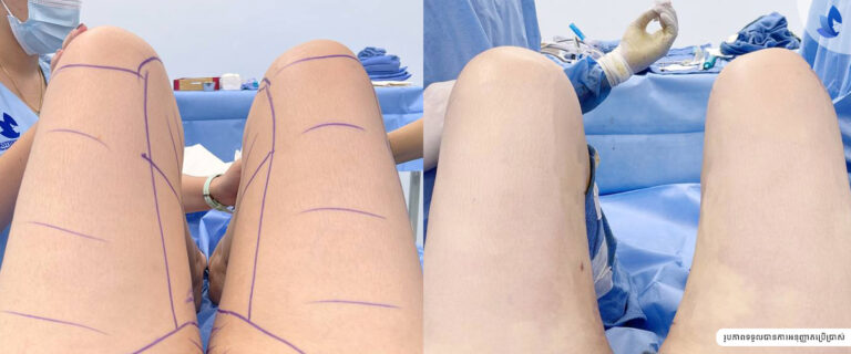 LIPOSUCTION Thigh