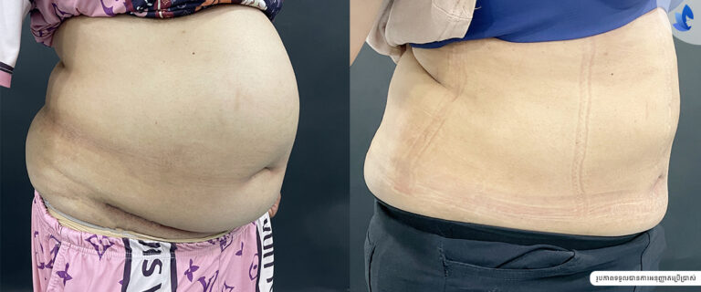 LIPOSUCTION big size