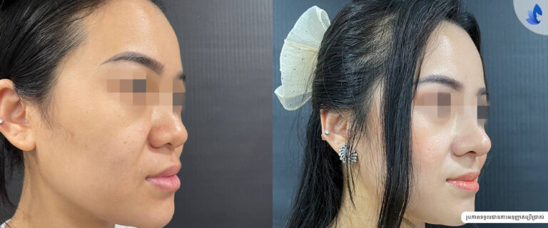 Rhinoplasty_